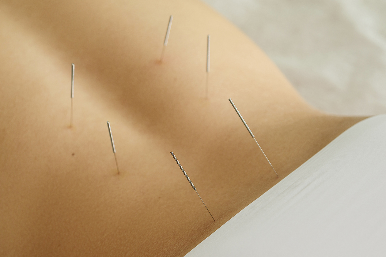 infertility acupuncture