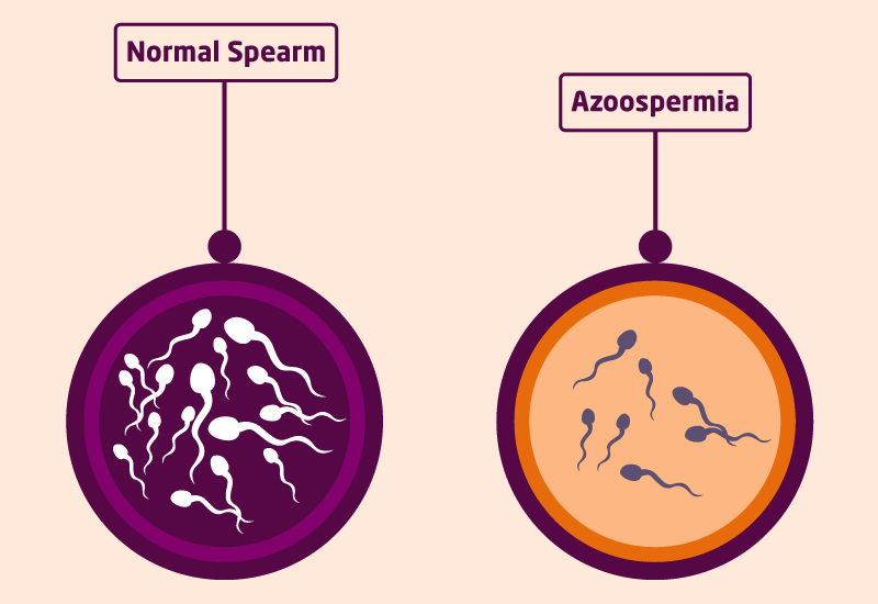 Azoospermia