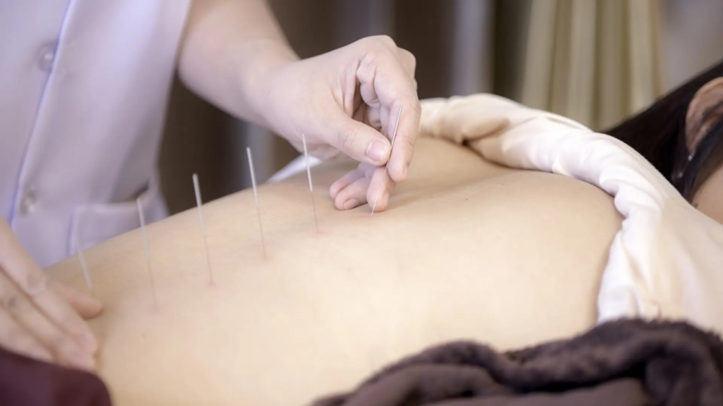 Acupuncture in Treating Infertility